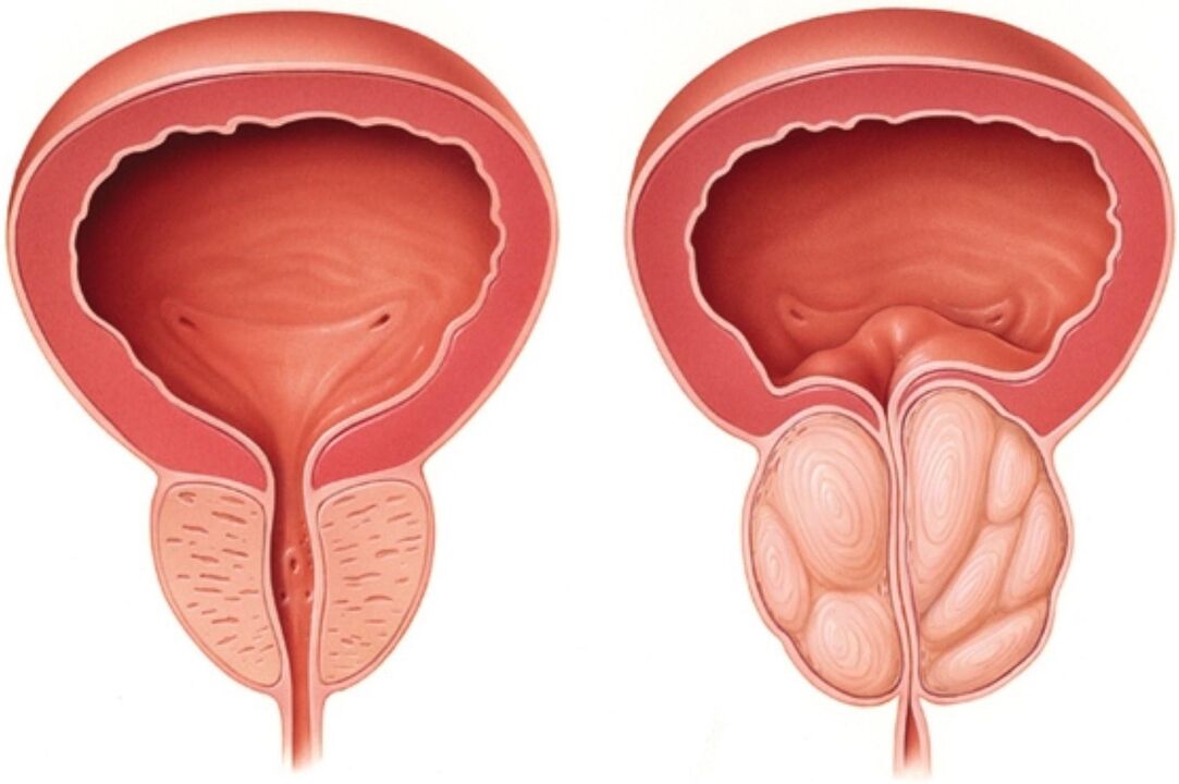 Normal prostate (left) and with signs of inflammation in prostatitis (right)