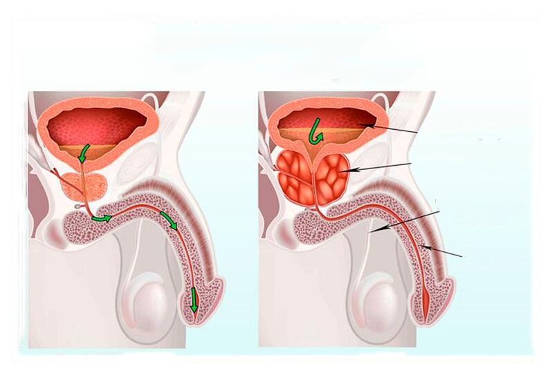 Norm and inflammation of the prostate gland
