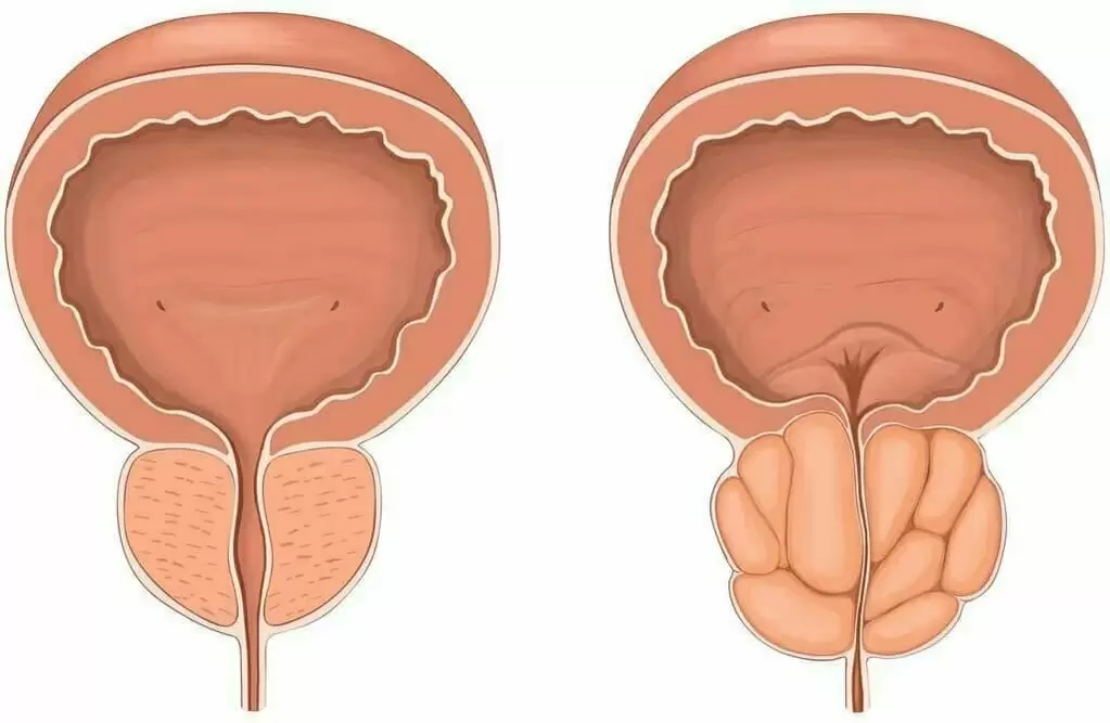 Normal prostate and inflamed prostate